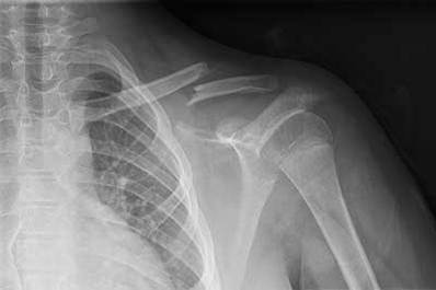 Shoulder