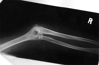 Elbow